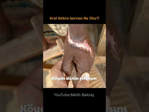 Kral Kobra Saldırısına Uğrayan Adam