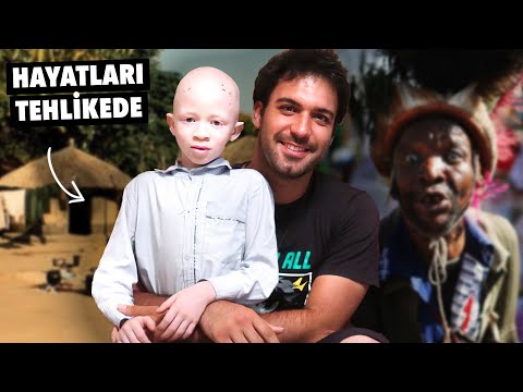 TANZANYA'da Albinolar NEDEN Öldürülüyor? (Röportaj)