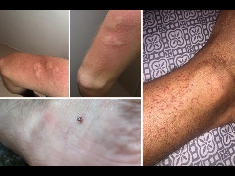 Tahta Kurusu, Bed Bug ve Kene İle Olan Tecrübelerim